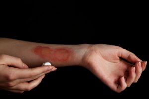 An arm with a red patch of skin.