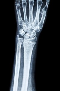 An X-ray of a wrist.