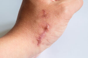 A scar on a person's hand following negligent laser hair removal treatment.