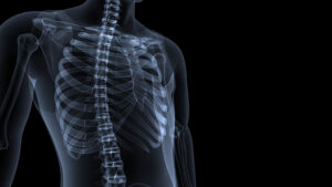 A graphic depicting an X-ray scan of a person after a rib injury