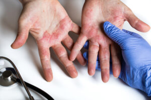 Dermatologist looking at dermatitis on patient's hands.