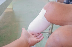 Close up of bandaged amputee at knee.
